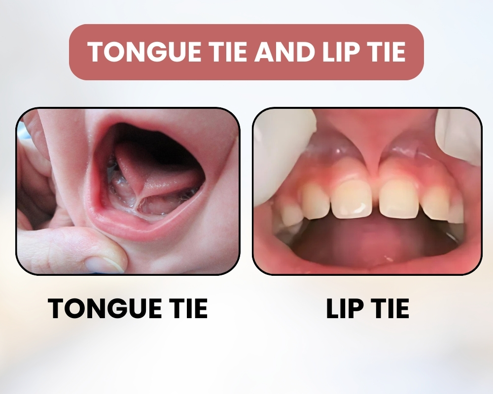 Tongue Tie and Lip Tie